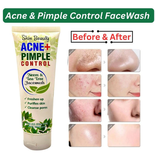 Acne+ Pimple Face Wash , Whitening 100 Ml  Free Delivery